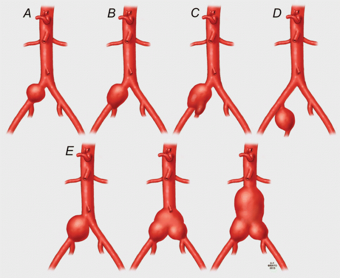 Classification Systems Relevant to Complex Endovascular Aortic Repair ... How to download apps on samsung smart tv