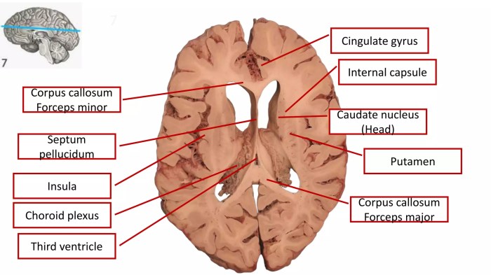 Surgical landmarks and sectional anatomy in neurosurgery | PPTX How to remove ear water